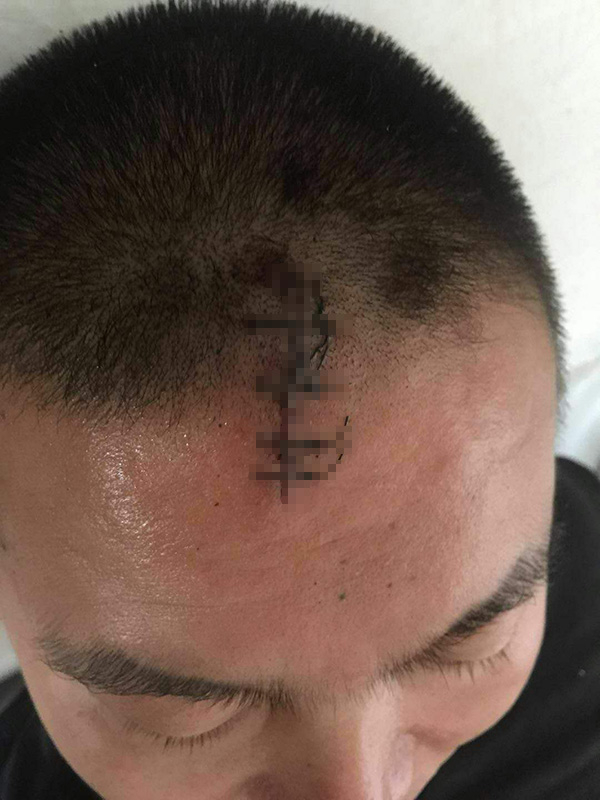 店主巩伦仁被城管打得满脸是血，额头留下一道4厘米的伤口。 &nbsp;本文图片均为巩伦仁提供