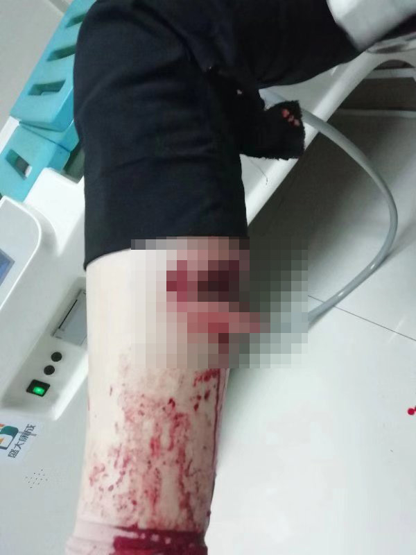 黄建华被狗咬后伤口。