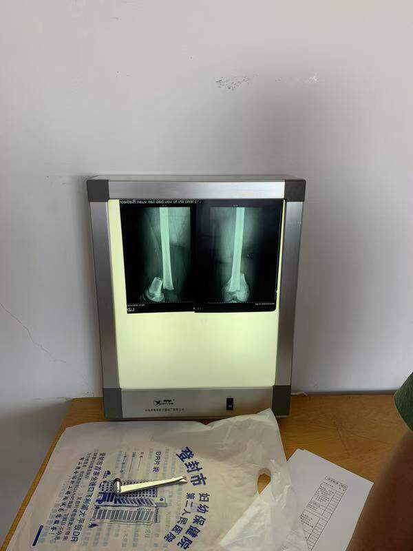 李文骨折伤情的照片 本文图均为 受访者李文的父亲 供图