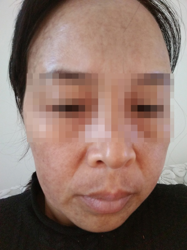 刘女士使用三个月后的皮肤 受访者刘女士供图&nbsp;
