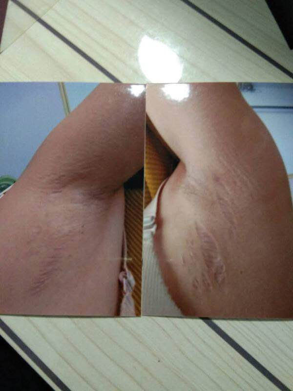 刘云急剧增胖后身体多处出现裂纹。当事人 供图