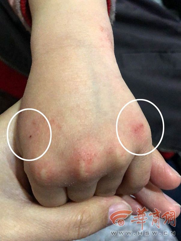 西安一幼儿园老师被指针扎多名幼童,警方和教育部门介入调查