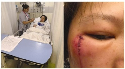 　当事人受伤缝针后的模样