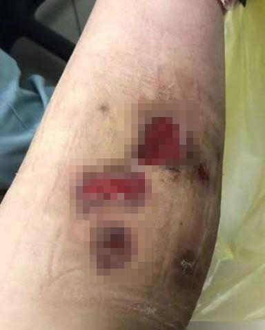 李女士久治不愈的溃烂 浙江24小时 图
