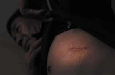 贾广日向记者展示2008年自己遇袭后的伤疤。