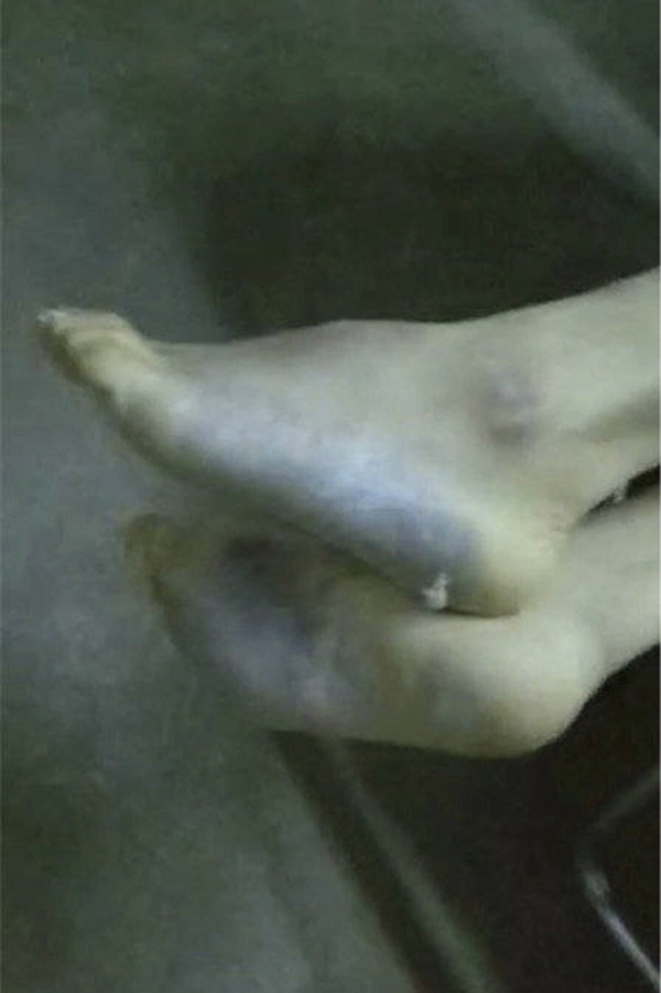 王磊足底皮下出血（监控视频截图）