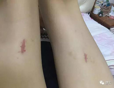 目前的现状，伤口处留下伤疤。