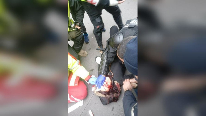 里格涅尔眼睛被击中后，她的男朋友拍下了这张照片