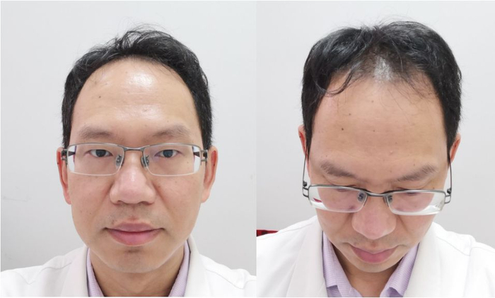 手术方法选择：FUE&nbsp;