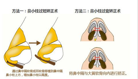 鼻小柱