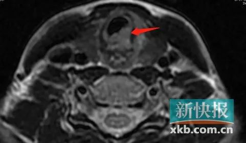 孕妇喉梗阻拒绝切开气管 腹中宝宝喘不过气了__财经头条
