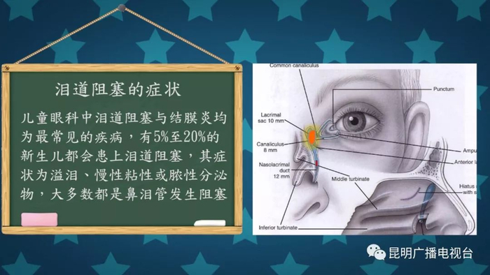 视频|《K讲堂 儿科专家来了》干货！孩子得了先天性泪道阻塞？快看看有没有这些症状表现↓↓