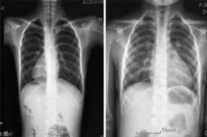 △右边为正常人X光片