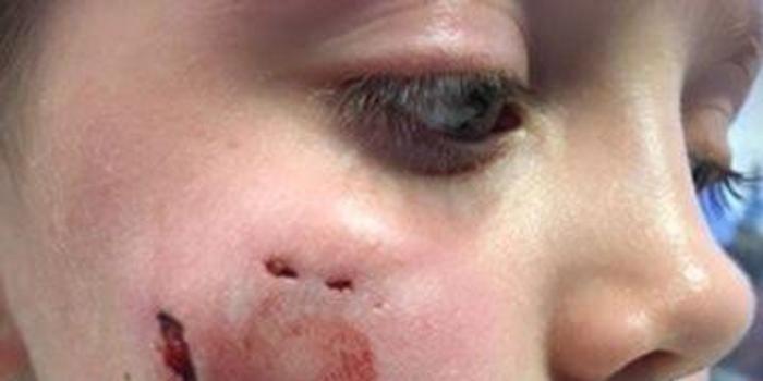 哈士奇抢7岁小女孩食物 在其脸上咬出4个血洞