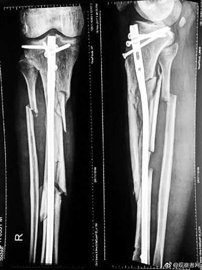 张毅被人用镐打成严重骨折