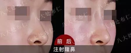 玻尿酸隆鼻