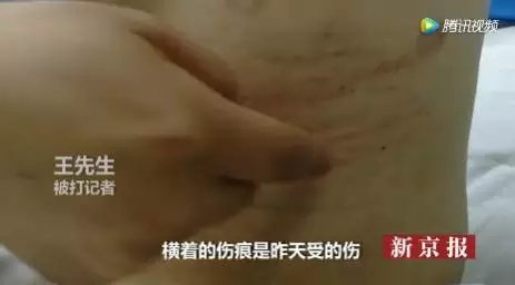 被打记者身上的伤痕。图/“我们视频”截图