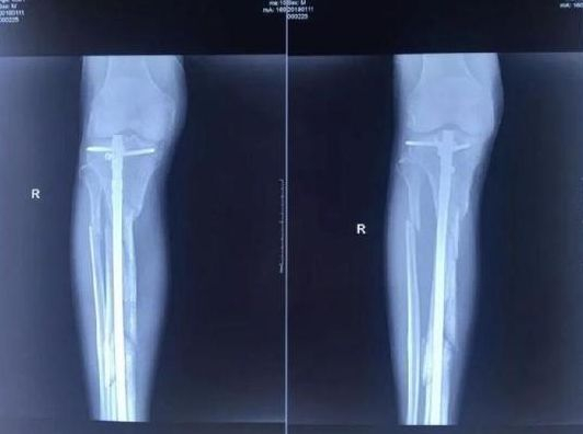 ▲张毅生前遭人殴打致骨折。图片来自北京晨报