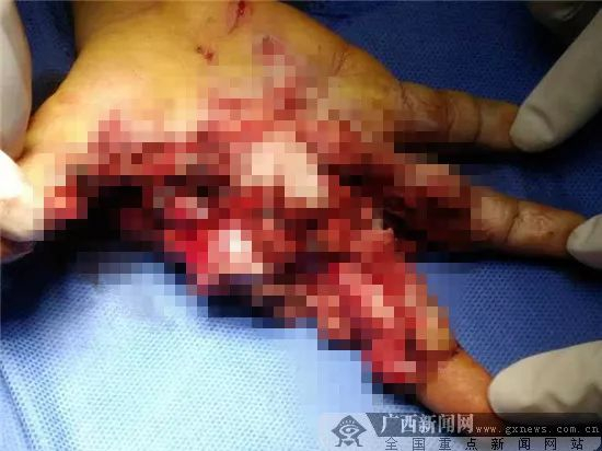 ▲手机爆炸致使孩子受伤严重。