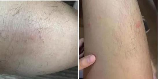 入住后身上曾出现的皮疹