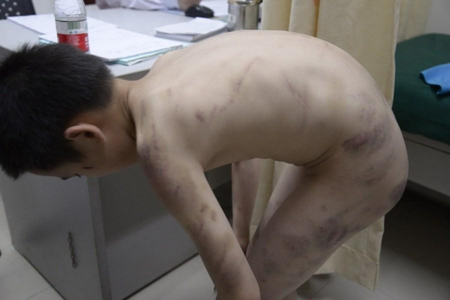 广东河源男童遭继母家暴遍体鳞伤