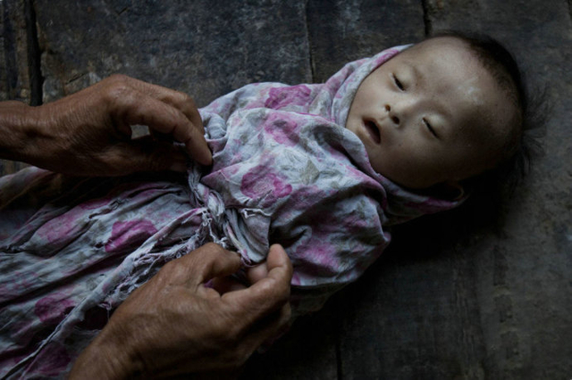 被抚养了六个月的智障孩子因病死亡