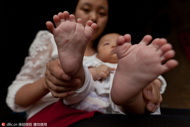 3月大男婴手指脚趾31根