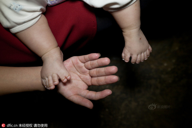 3个月大男婴患多指症 手指脚趾总共31根