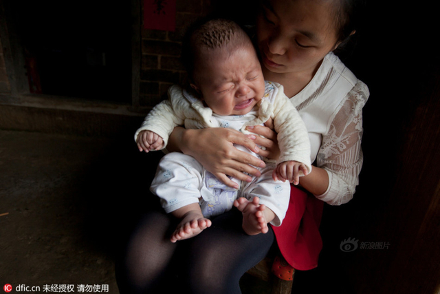 3个月大男婴患多指症 手指脚趾总共31根