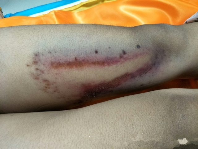 济南女大学生裸体坠楼身亡 尸体满身伤痕