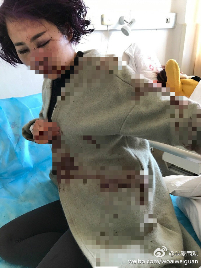 女子自称在丽江遭围殴毁容
