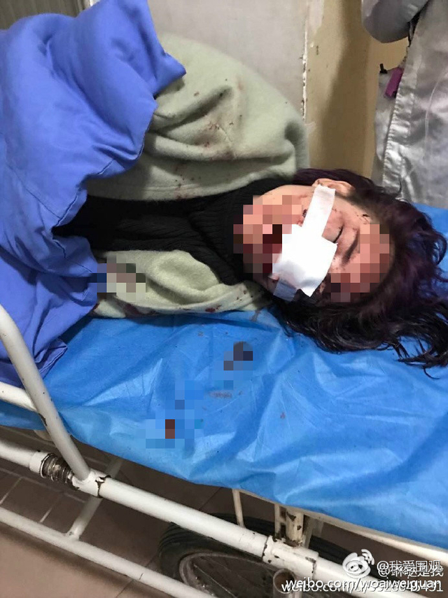 女子自称在丽江遭围殴毁容