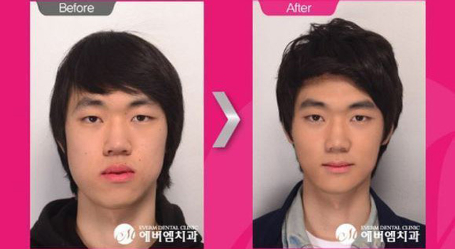 真人出镜：韩国整容前后对比照