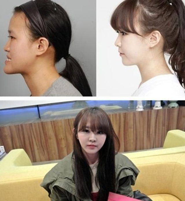 真人出镜：韩国整容前后对比照