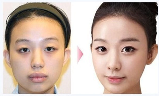 真人出镜：韩国整容前后对比照