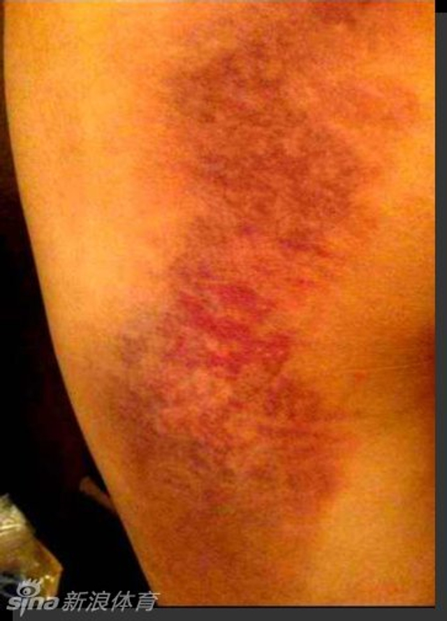 陈楚生大腿受伤照片