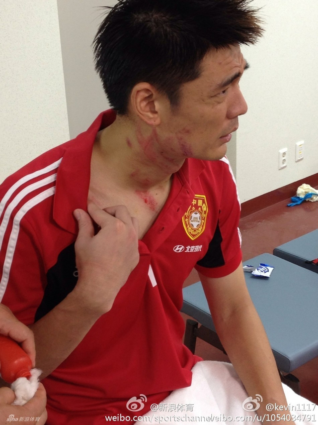 曾诚微博展示伤情