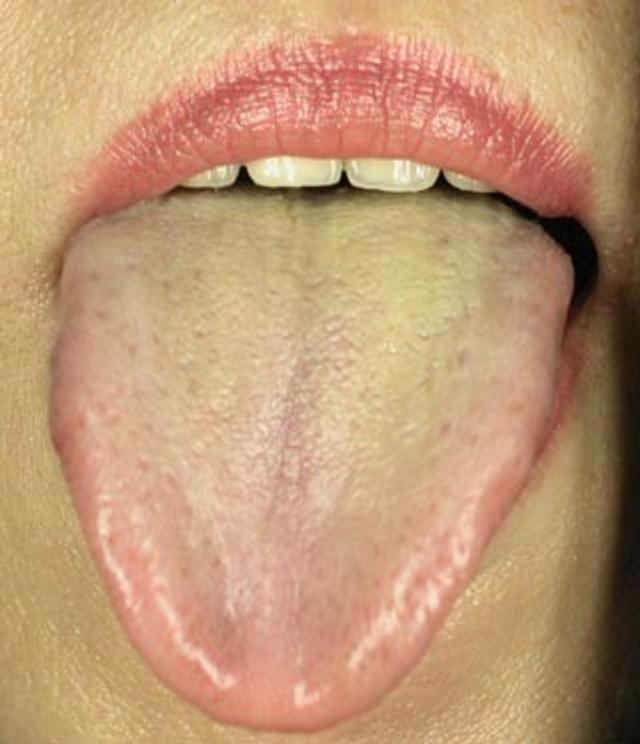 看舌苔了解自己健康状况 新浪图片