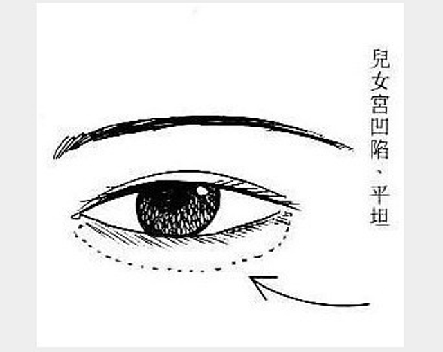 眼下“儿女宫”凹陷