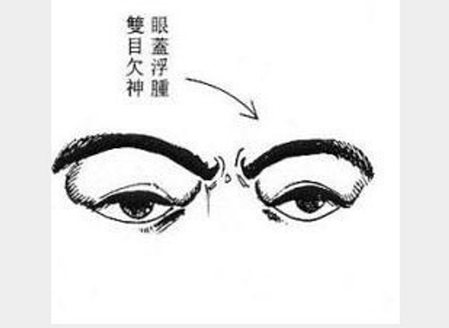 眼皮浮肿，双目欠神