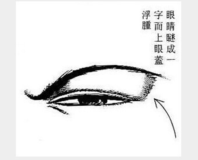 眼睛眯成一字，上眼皮浮肿