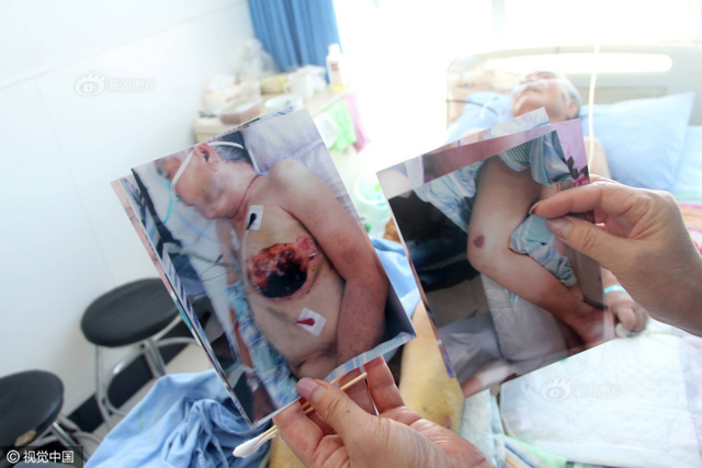 东营老人遭儿子儿媳虐待 乳房被烙铁烫平